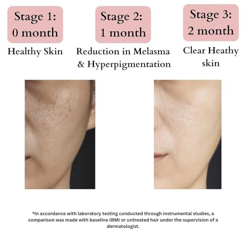 BLUSHLIN 10% Tranexamic Acid Cream with 2% Kojic Acid + 5% Vitamin C + 1% Arbutin | Pigmentation Removal Face Cream | Helps Even Skin Tone, Reduce Dark Spots, Blemishes and Scars - 10gm(FROM INDIA)JEZ - View 2 of 4