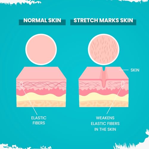 Gynocup Stretch Marks Removal Cream for Pregnancy with the Goodness of Shea Butter, Coco Caprylate, Glycerine and Aloe Vera, Harsingar Oil &amp; Vitamin E (50 G) (Stretch Marks Removal Cream 50G) Pack of 1 (FROM INDIA)SAB - View 3 of 6