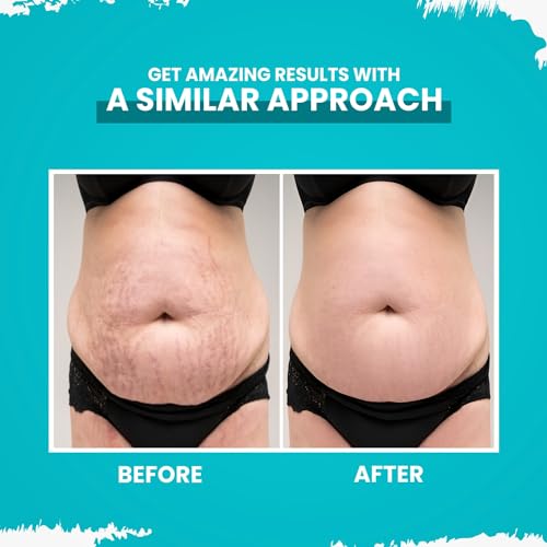 Gynocup Stretch Marks Removal Cream for Pregnancy with the Goodness of Shea Butter, Coco Caprylate, Glycerine and Aloe Vera, Harsingar Oil &amp; Vitamin E (50 G) (Stretch Marks Removal Cream 50G) Pack of 1 (FROM INDIA)SAB - View 5 of 6