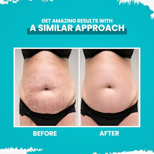 GYNOCUP Stretch Marks Removal Oil 100 ml | Minimises Stretch Marks, Improves Skin Texture | Pomegranate, Sunflower, Olive &amp; Turmeric Oil | Safe For Pregnant Women | Scar Removal Toxin Free Oil (FROM INDIA)SAB - View 5 of 6