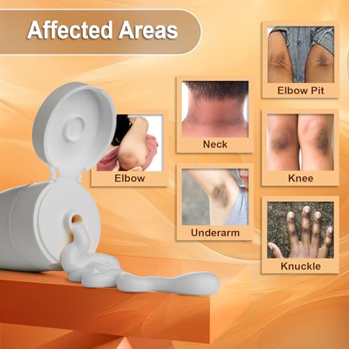 COZMIX Derma Re-White Dark Patch Removal Cream | Knee &amp; Elbow Cream | Neck &amp; Underarm Cream | Dark Patches Corrector | Underarm Cream | Cream For Spots &amp; Uneven Skin Tone, 80 gm (FROM INDIA)SAB - View 4 of 5