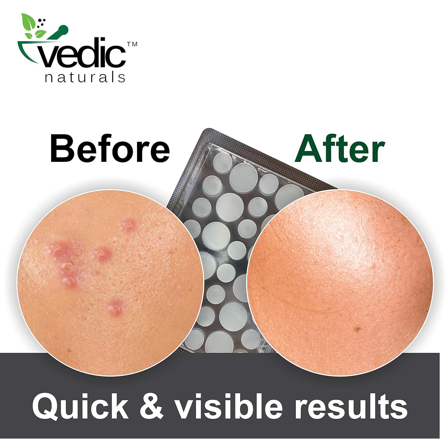 Vedic Naturals Acne Pimple Patches For Face &amp; Skin Treatment Cover With 100% Hydrocolloid Transparent Patch, Fast Pimple Healing, Drug Free, Non Drying &amp; Water Proof - 36 Patches - Pack Of 1 - View 2 of 7