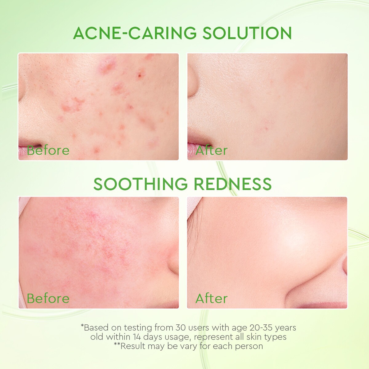 Glad2Glow KIWI 3D Acid Acne Moisturizer Acne Treatment Night Day Cream Face Acne Cream Skincare Moisturiser-3pcs(FROM MALAYSIA) - View 2 of 4