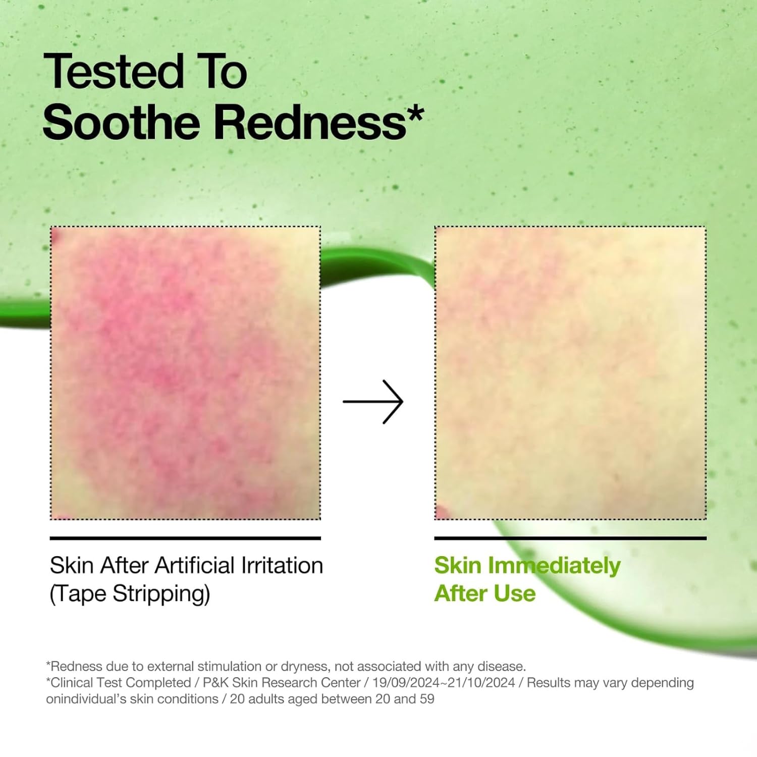 Rhod Azelaic Acid 10 Hyaluron Soothing Serum, Facial Serum For Sensitive Skin, Hyaluronic Acid, Niacinamide, Spot Care, Natural Color, Vegan, Korean Skincare (30Ml/ 1.01 Fl Oz.) - View 3 of 4