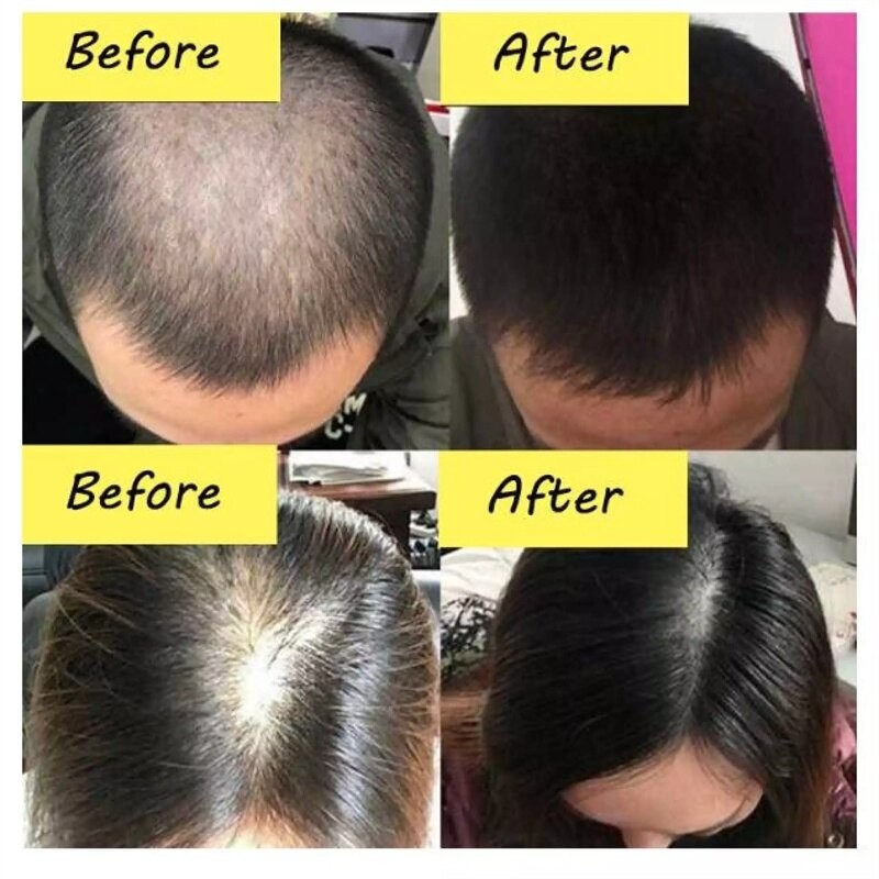 serum rambut gugur Hair Growth Essential Oil Hair growth serum hair loss improve hair follicles 頭發營養水精油生發液(FROM MALAYSIA) - View 2 of 4