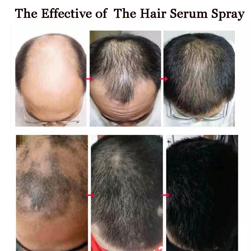 serum rambut gugur Hair Growth Essential Oil Hair growth serum hair loss improve hair follicles 頭發營養水精油生發液(FROM MALAYSIA) - View 3 of 4