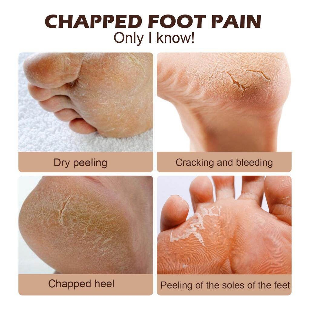 Foot Treatment Cream Anti-Cracking Moisturizing Foot Care Repair Dry Cracked Skin Anti-Dryness Anti-Chapping Deep Hydration Softening Heel Care Daily Use Smooth Skin Recovery Balm - View 2 of 3