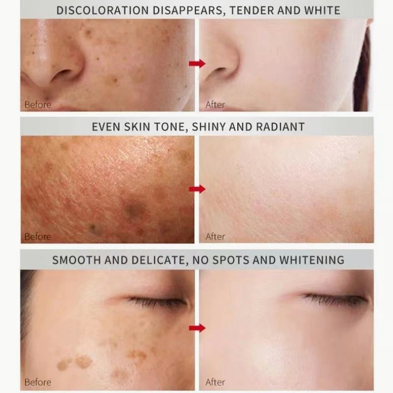 Yunnan Herbal Melasma Cream White Spot Cream 30g Face Moisturizer Freckle Removal Whitening Skin Care Cream for Dark Spots, Melasma, Uneven Skin Tone Brightening Daily Facial Treatment Herbal Formula Use - View 2 of 3