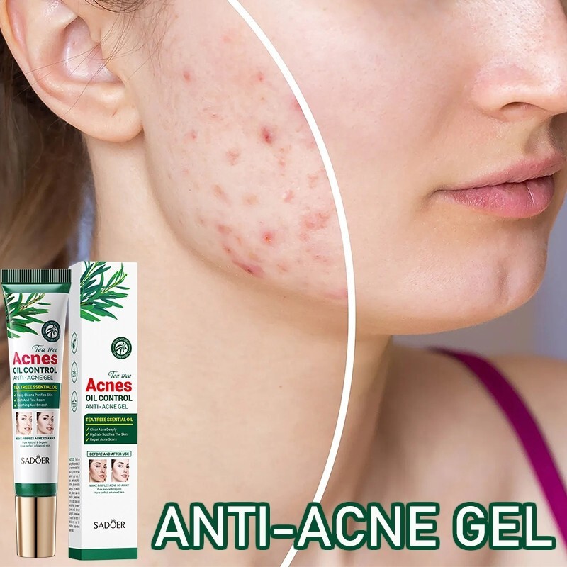 SADOER Tea Tree Acne Removing Cream 20g Tea Tree essence Acne Removing&Oil Controlling Moisturizing Student Acne Printing gel，Fade acne marks, remove acne, shrink pores, plant essence, anti-acne gel 祛痘霜- 1 bottle(FROM MALAYSIA) - View 2 of 3