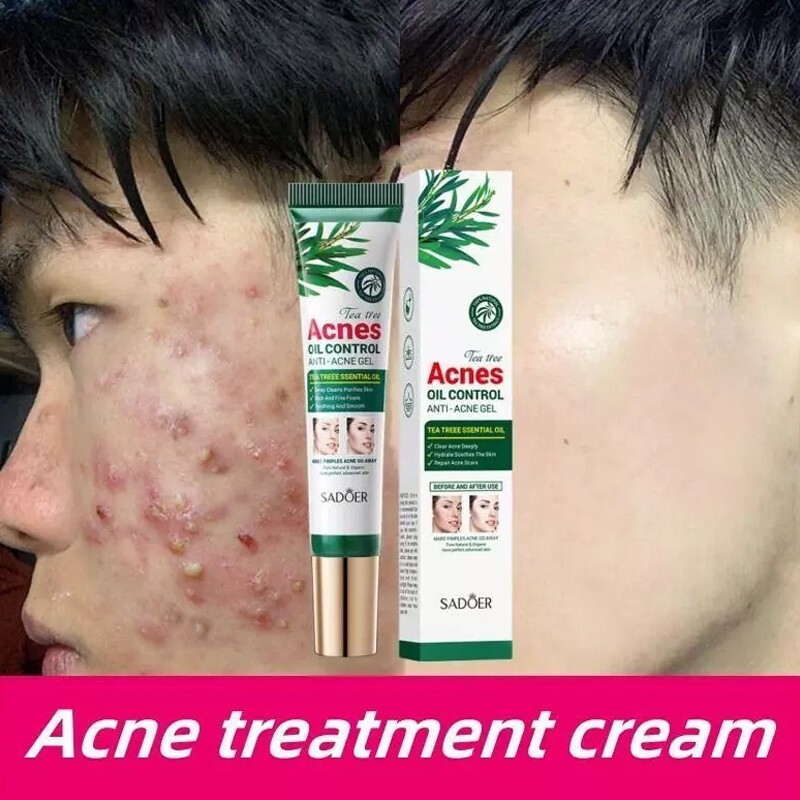 SADOER Tea Tree Acne Removing Cream 20g Tea Tree essence Acne Removing&Oil Controlling Moisturizing Student Acne Printing gel，Fade acne marks, remove acne, shrink pores, plant essence, anti-acne gel 祛痘霜- 2 bottle(FROM MALAYSIA) - View 3 of 3