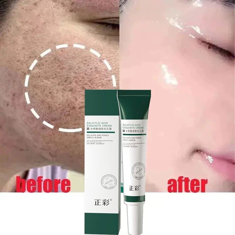 Salicylic Acid Pores Shrink Refining Cream Repair Large Open Pore Removal Black Dots Blackhead Acne Marks Facial Skin Care Serum Salicylic Acid Pores Shrink Refining Cream 水杨酸凝胶20g-1pcs (FROM MALAYSIA) - View 3 of 3
