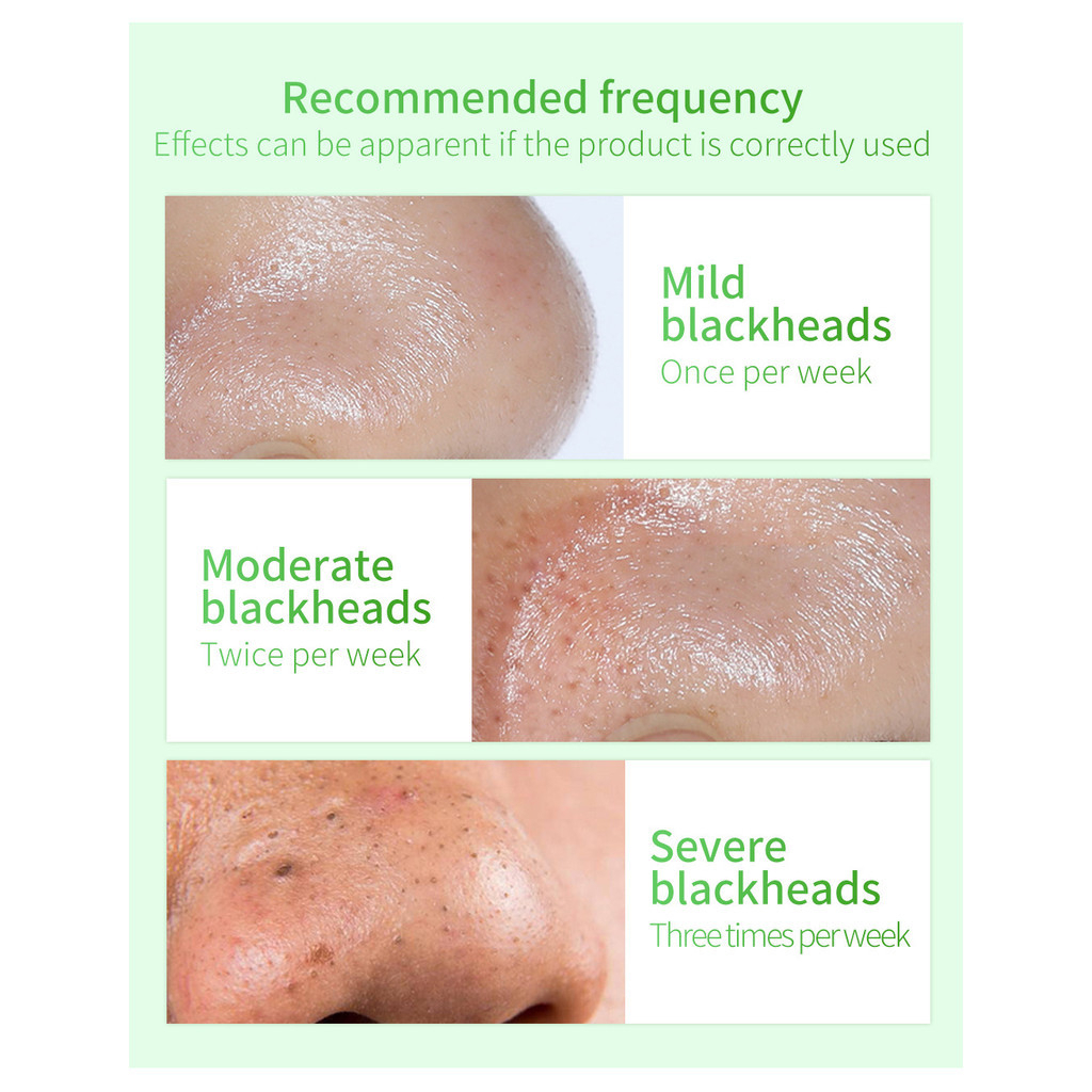 LANBENA Blackhead Remover Mask 17ml – Deep Pore Cleansing Peel-Off Mask for Blackheads, Pimples & Acne Care for Clear, Smooth Skin - View 3 of 3