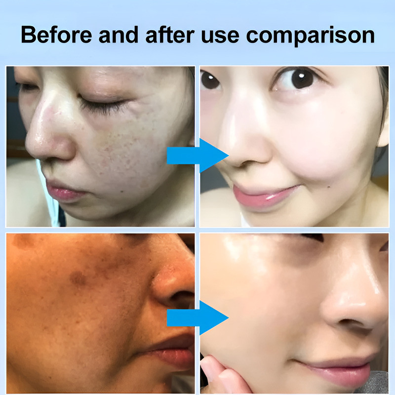 Vitamin E Urea Cream 100% Authentic Chicken Skin Body Lotion 200ml Fades Age Spots Yellow Spots Acne Scars Wrinkles Hydrating Smoothing Keratosis Pilaris Treatment Moisturizing Skin Repair Body Cream Formula - View 2 of 3