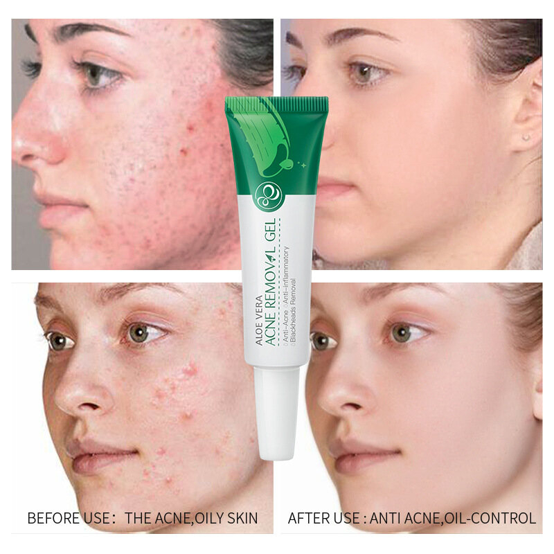 LAIKOU Aloe Vera Acne Removal Gel Anti-Acne Anti-Inflammatory Blackhead Care Soothing Hydrating Skin Treatment Gel for Clear Smooth Healthy Looking Skin Daily Use 20g - View 3 of 3
