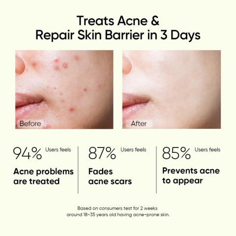 SKINTIFIC 2% Salicylic Acid Anti Acne Serum 20ml | Spot Treatment Brightening Face Serum | Acne & Scar Care | Helps Clear Breakouts, Refine Pores and Support Healthy Skin Barrier Repair - View 3 of 3