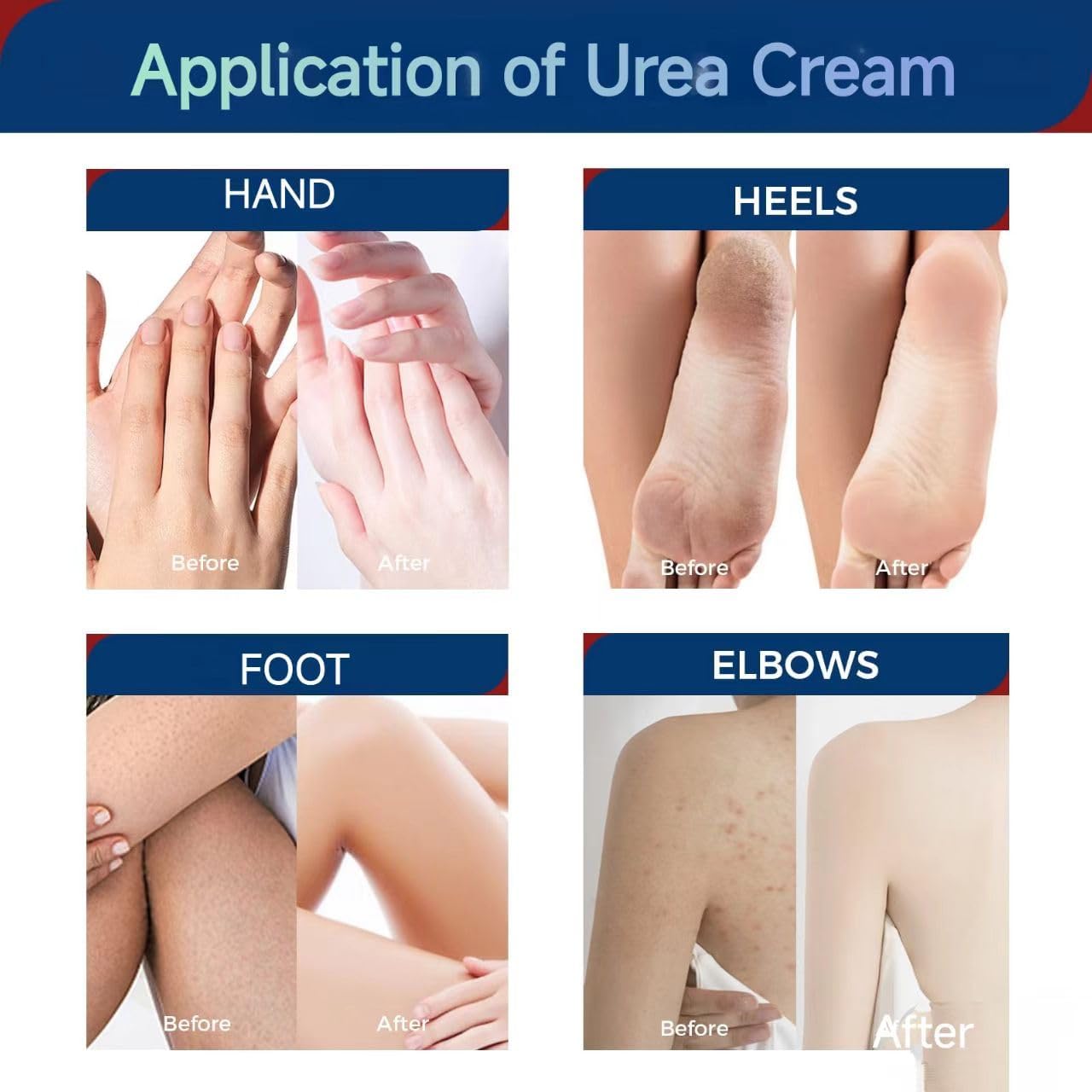 OUKEYA Urea Cream 42 Percent with 2% Salicylic Acid Tube 3 Oz, Foot & Hand Cream for Dry Cracked, 40 per Urea Lotion for Feet Maximum Strength, 85g, 2 Pack - View 4 of 7