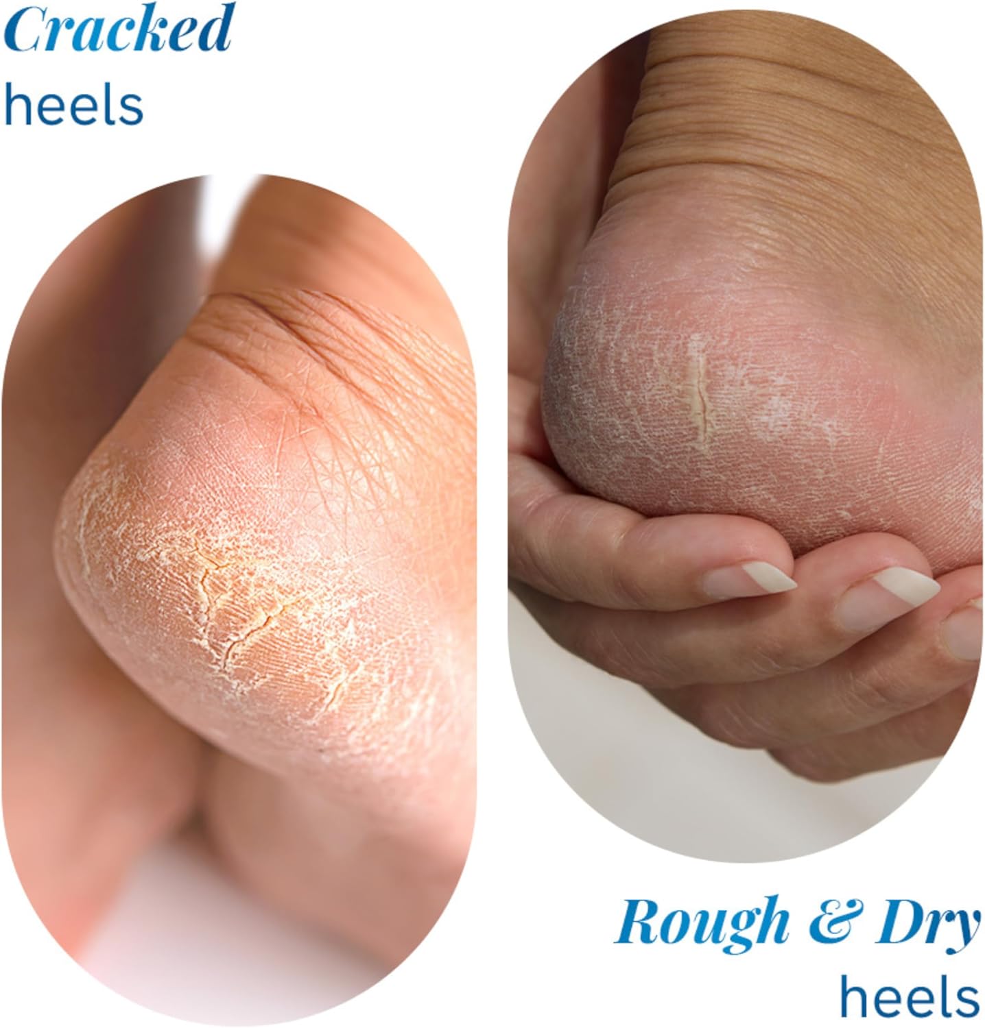 Be Bodywise 20% Urea Foot Cream Roll On | Repairs Dry & Cracked Heels | 2% Lactic Acid, Olive Oil & Vitamin E I Exfoliates & Softens Skin I Hydrates & Moisturises INo Irritation IAll Skin TypesI 50 ml - View 6 of 8