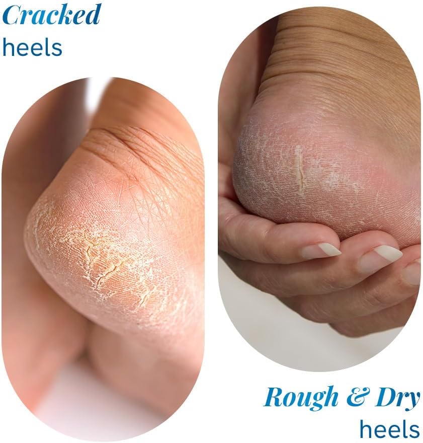 Be Bodywise 20% Urea Foot Cream Roll On | Repairs Dry & Cracked Heels | 2% Lactic Acid, Olive Oil & Vitamin E I Exfoliates & Softens Skin I Hydrates & Moisturises INo Irritation IAll Skin TypesI 75 ml - View 4 of 5
